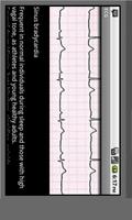 Electrocardiogram ECG Types